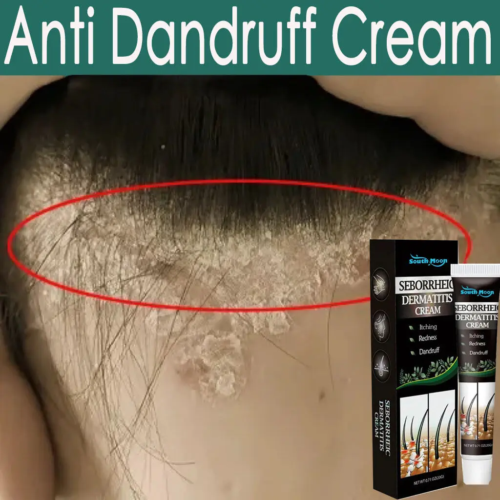 Anti Dandruff Cream for Scalp Itching and Dandruff for Men & Women,anti Hair Loss Nourish Hair Fast Growth Cream,hair Treatments/Natural Cream for Psoriasi Eczma 20g