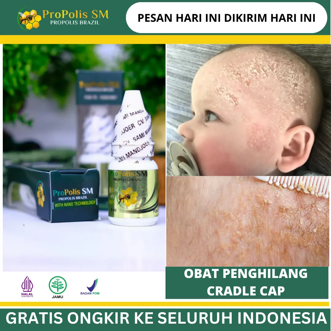 Cradle Cap, Penghilang Cradle Cap, Kulit Mengelupas Gatal, Ketombe Berkerak, Kepala Biang Keringat Bernanah, Alergi Kulit Sensitif, Jamur Kulit Kepala Bayi, Psoriasis Kepala, Dermatitis Seboroik Dengan Propolis Sm