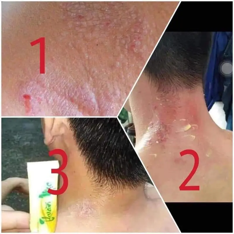 Thuần mộc bôi da kem bôi da thuần mộc nấm ngứa hắc lào Thanh Mộc Hương 8