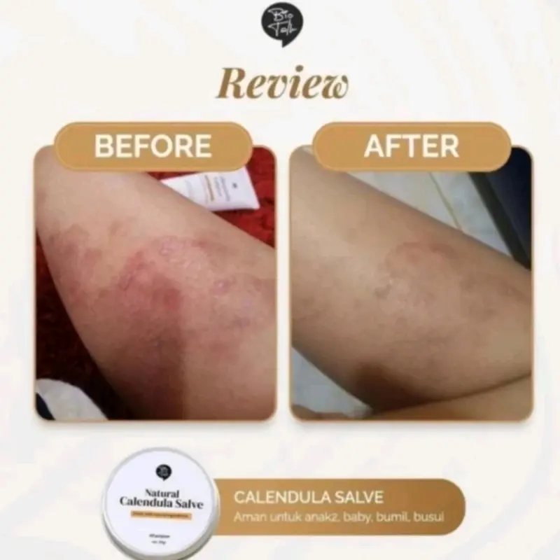 BỊO TALK NATURAL CALENDULA SALVE FOR ECZEMA BEKAS LUKA BIO TALK BPOM 4