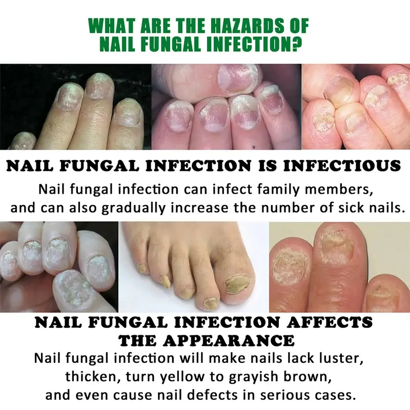 EELHOW Nail Repair Gel Strengthen Brighten Toenails Foot Nail Care Treatment Ginger Kutek 2