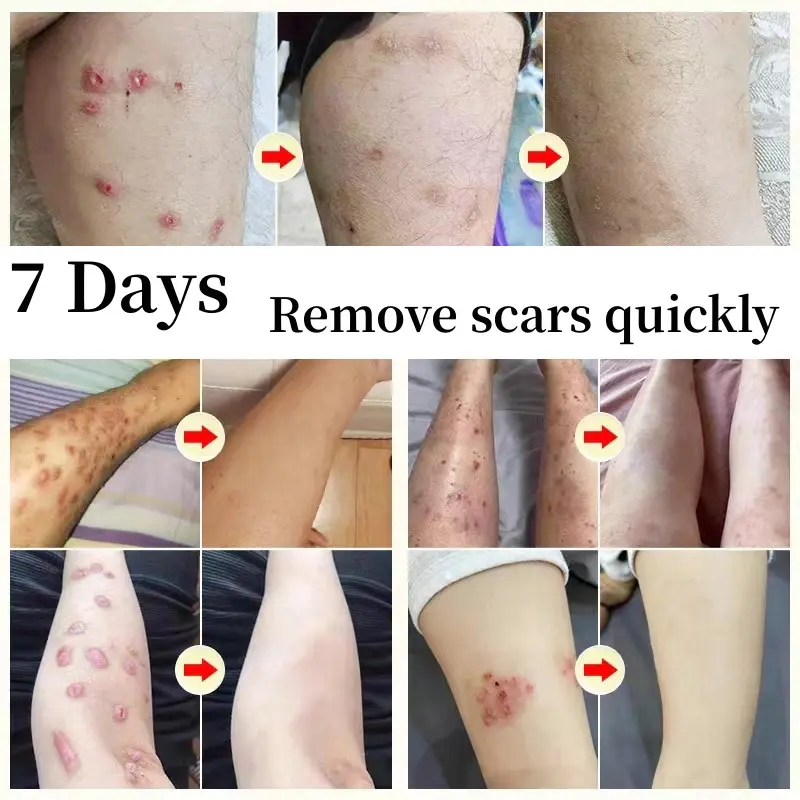 Salep Penghilang Bekas Luka Susu Tubuh Penghilang Bekas Luka Koreng Hitam Penghilang Bekas Luka Gigitan Nyamuk, Stretch Mark, Penghilang Bekas Luka Jahitan 2