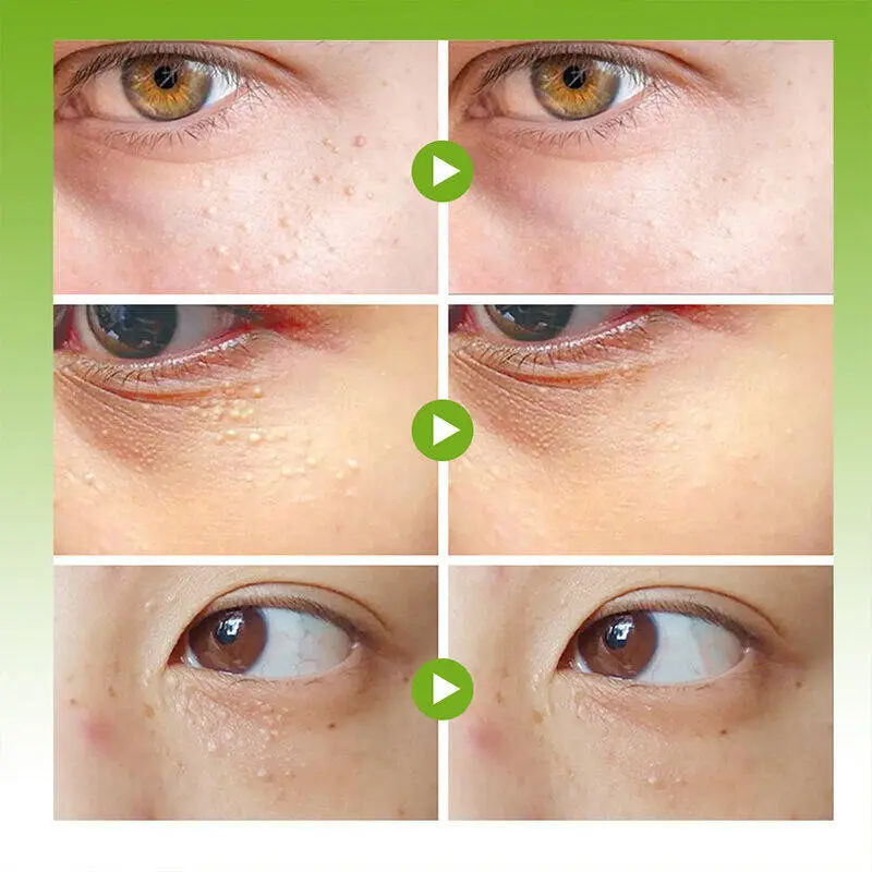 Krim Herbal Penghilang Milia dan Bintik Lemak Area Mata & Hidung dengan Vitamin E - Perawatan Wajah 20g | Formula Alami Efektif 1