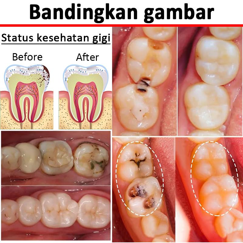 Japan Obat Sakit Gigi Berlubang Paling Ampuh Penghilang Gusi Bengkak Linu Ngilu Bernanah Nyeri Sariawan Anak Dewasa Cairan Tetes-Obat Gusi Bengkak Nyut Nyutan 20ml [B58]
