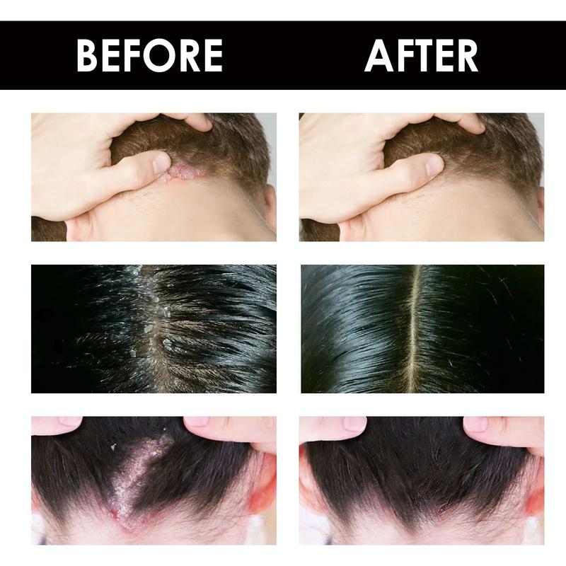 Product Introduction of Anti Dandruff Cream for Scalp Itching and Dandruff for Men & Women,anti Hair Loss Nourish Hair Fast Growth Cream,hair Treatments/Natural Cream for Psoriasi Eczma 20g 8