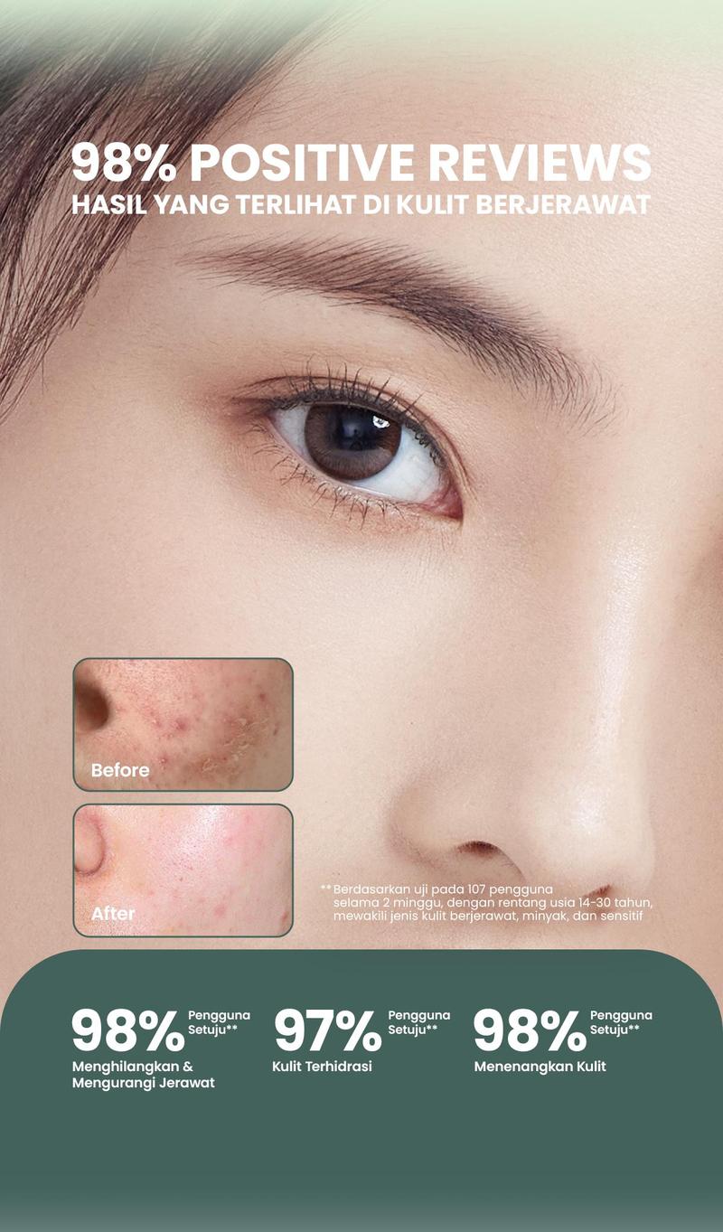 Product Introduction of ✨MJ 100% ORI✨ YOU AcnePlus Multi-Action Skin Cream | Moisturizer Anti Jerawat | Kulit Berminyak | Menghidrasi | Bebas Jerawat Treatment Wajah Berjerawat Perawatan Beruntusan 2