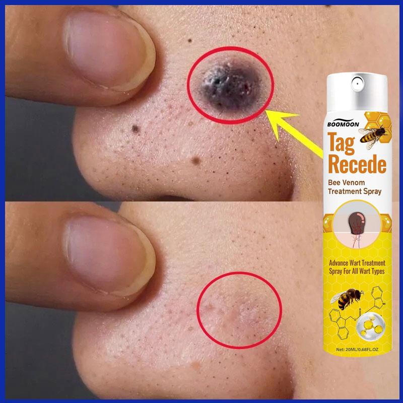 Penghilang Kutil Dan Tahi Lalat Obat Penghilang Kutil Penghilang Tahi Lalat Di Wajah Obat Kutil Ampuh Skin Tag Remover [S09]