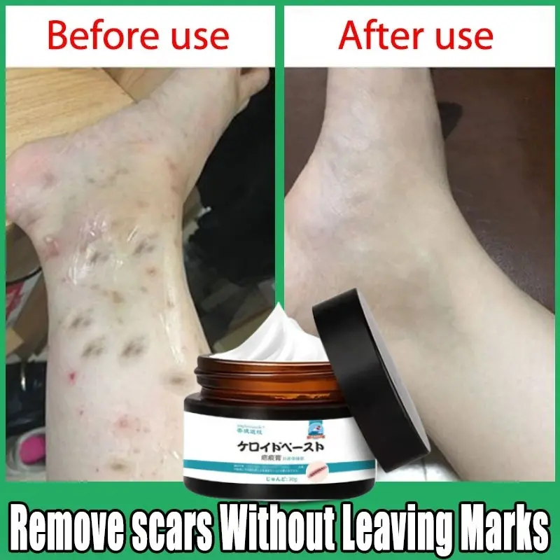 Salep Penghilang Bekas Luka Susu Tubuh Penghilang Bekas Luka Koreng Hitam Penghilang Bekas Luka Gigitan Nyamuk, Stretch Mark, Penghilang Bekas Luka Jahitan 8