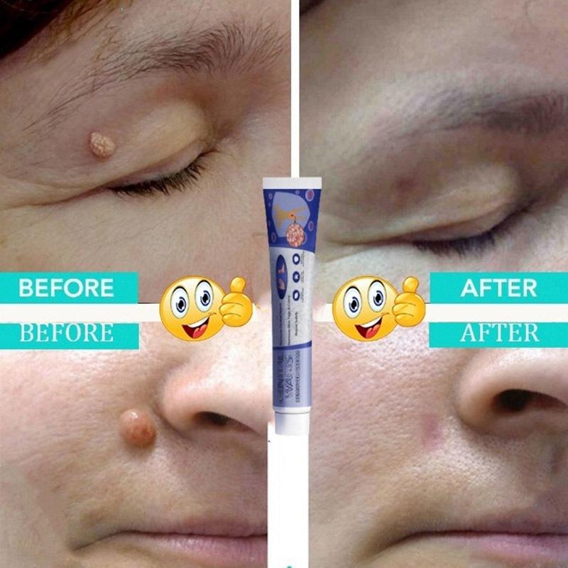 kem xoá mụn cóc,mụn thịt,loại bỏ mụn cóc thông thường,mụn đá,mụn cơm,mụn cóc dạng sợi 20g 2