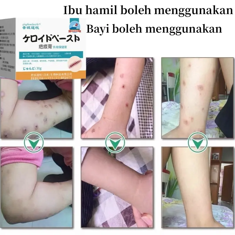 Salep Penghilang Bekas Luka Susu Tubuh Penghilang Bekas Luka Koreng Hitam Penghilang Bekas Luka Gigitan Nyamuk, Stretch Mark, Penghilang Bekas Luka Jahitan 4