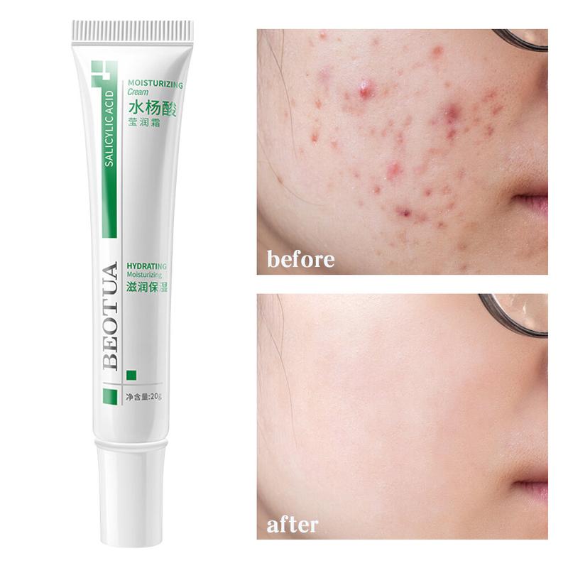 Kem Thu Nhỏ Lỗ Chân Lông Axit Salicylic, Xóa Mụn Nhanh Chóng, Loại Bỏ Lỗ Chân Lông Lớn, Loại Bỏ Mụn Đầu Đen, Làm Săn Chắc Da Mặt, Làm Mịn Da, Chăm Sóc Da, Sản Phẩm Mới 2024 7
