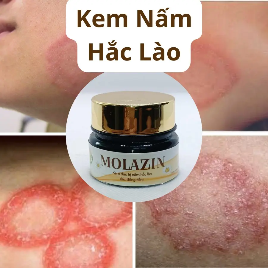 Kem bôi Nấm Hắc Lào Molazin