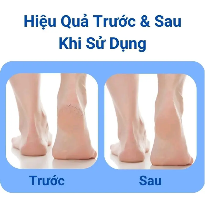 Combo 2 Chiếc Chà Gót Chân Giúp Làm Sạch Những Tế Bào Da Chết Ở Chân Trở Nên Mượt Mà, Chà Gót Chân 2 Mặt Tại Nhà 8