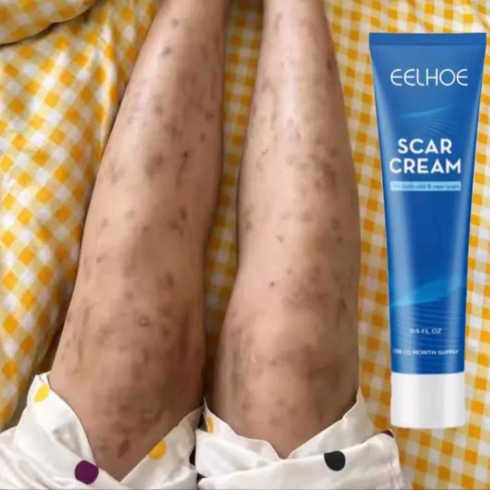 SCAR CREAM salep penghilang bekas luka bakar dan bekas luka koreng ...