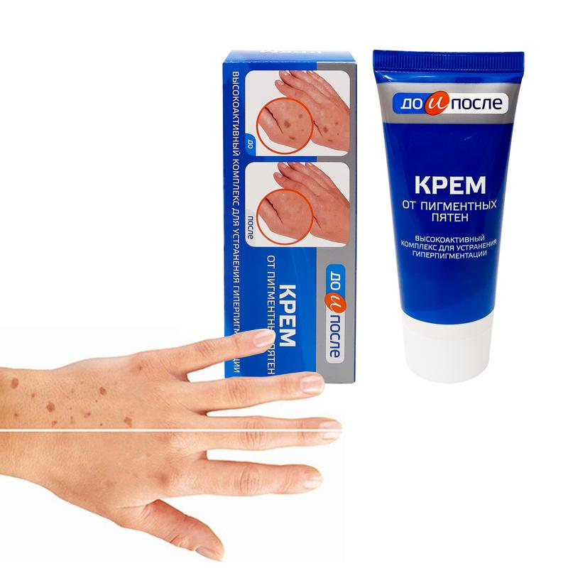 Kem Nám Tàn Nhang Đốm Nâu Da Tay Kpem Của Nga 45ml Kem Đồi Mồi Tay