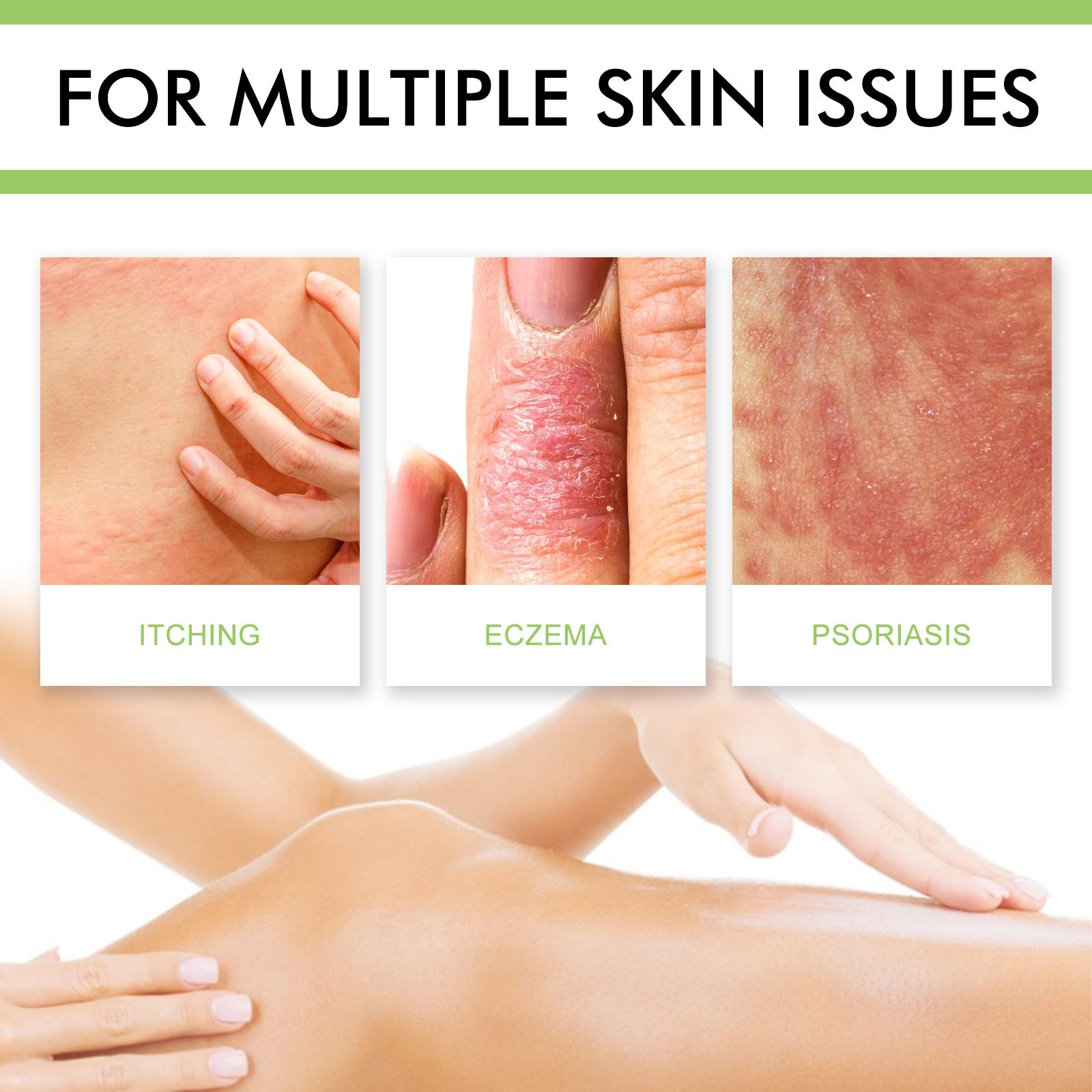 GATAL & KURAP LENYAP! South Moon Salep Rp69rb