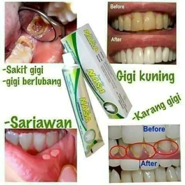 Pasta Gigi Nasa PGN Ekstrak Cengkeh Memutihkan & Merontokkan Karang Gigi - Gusi odol gigi sensitif 0