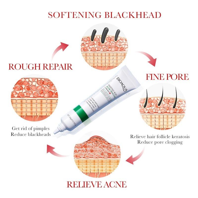 Kem loại bỏ mụn axit salicylic nhanh chóng loại bỏ mụn bọc Giảm Mụn Đầu Đen Và Mụn Trứng Cá 20g 3