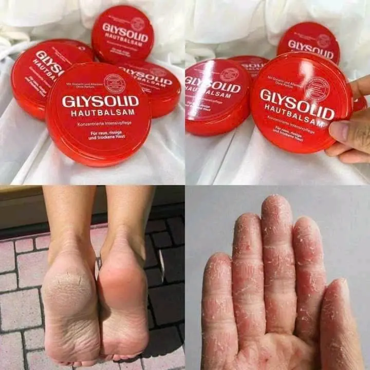 Kem chống nẻ GLYSOLID - chống nẻ da tay, trị nứt gót chân hiệu quả