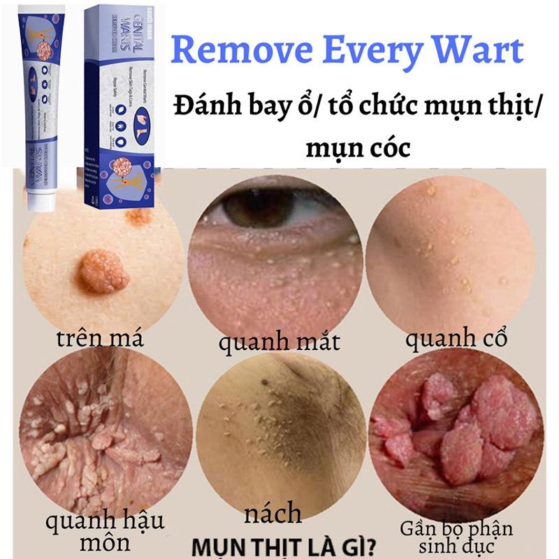 kem xoá mụn cóc,mụn thịt,loại bỏ mụn cóc thông thường,mụn đá,mụn cơm,mụn cóc dạng sợi 20g 6