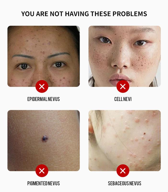 Product Introduction of Mole Removal Suit Mole Removal Mole Removal Health Liquid Care Cream 1