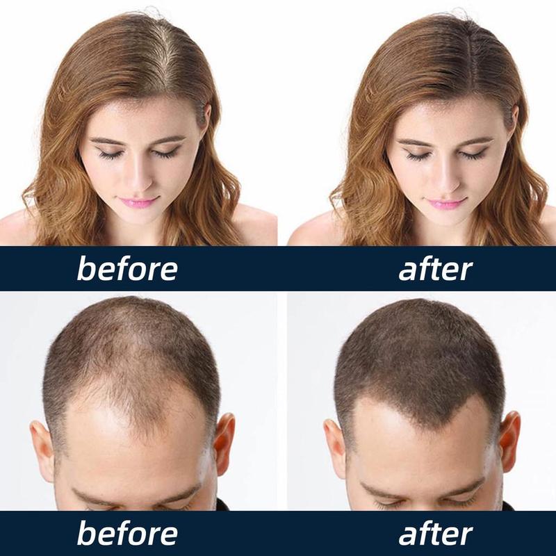 Product Introduction of Hair Anti Hair Loss Growerminoxidil Hair Growth Serum Fast 6% Minoxidil Strands Hair Growth Spray Hair Care Comfort 10