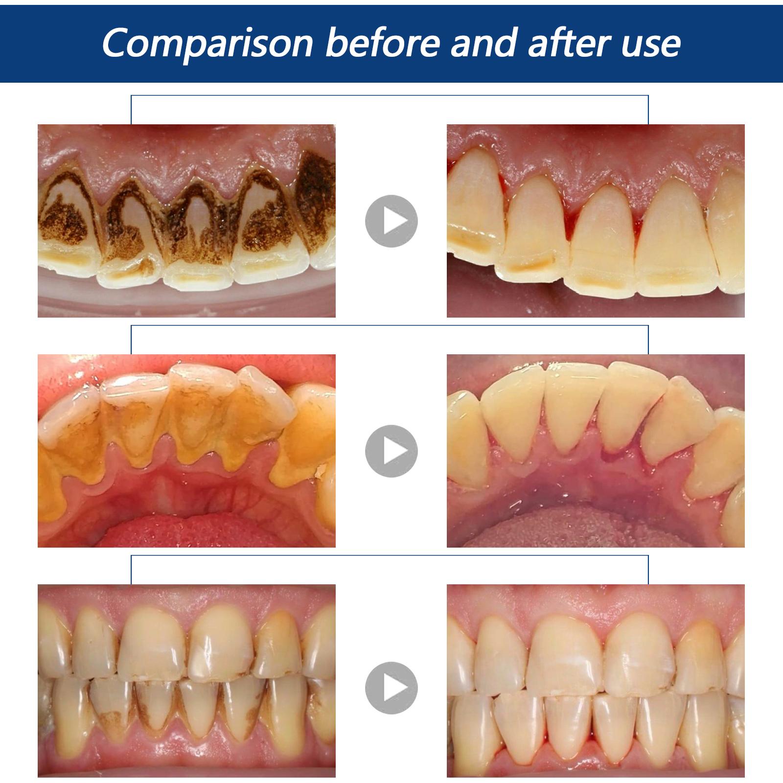 Penghilang Tartar Jaysuing Penghilang Tartar Pemutih Gigi Semprotan Penghilang Bau Mulut