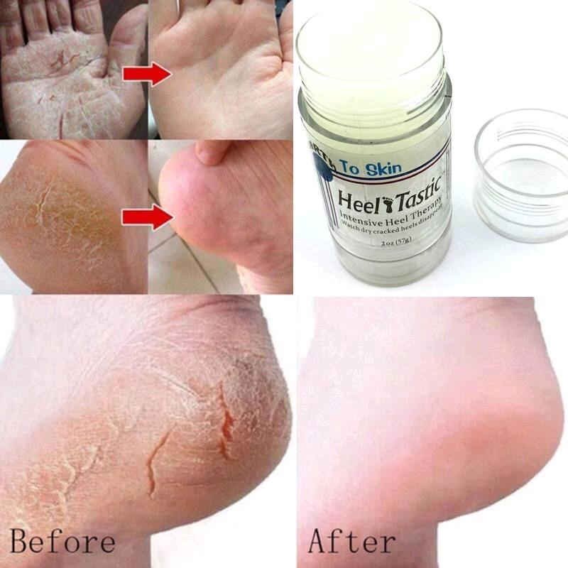 cream heel tastic therapy krim rawatan tumit kulit kaki merawat ...