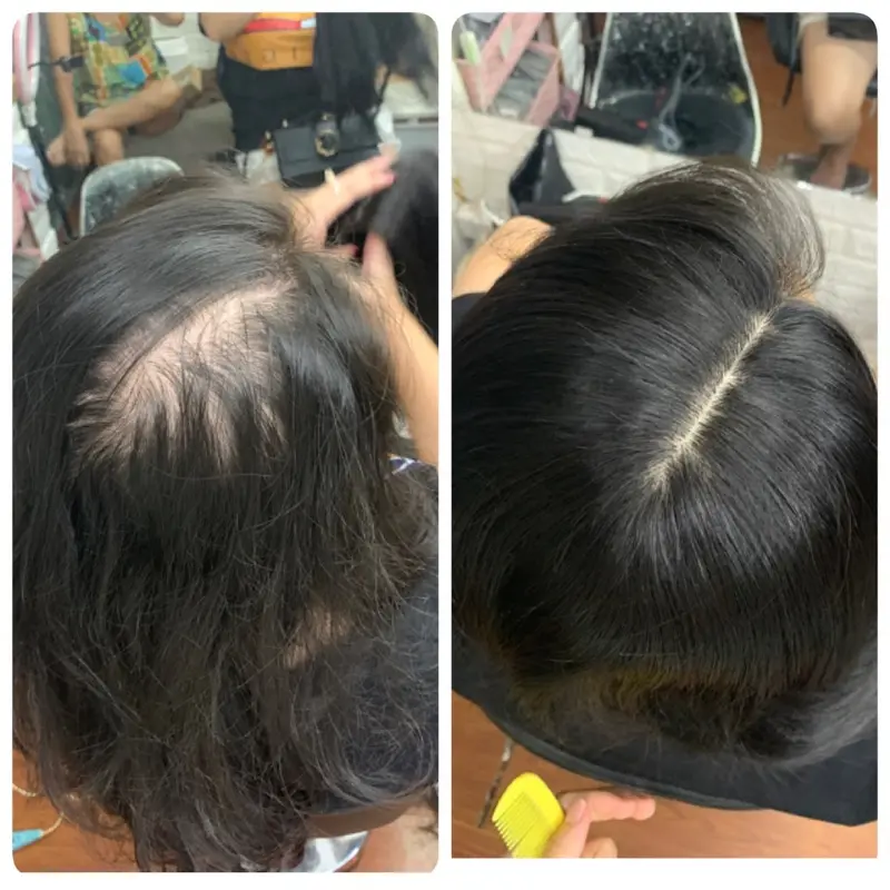 Siêu Da mono bản lớn 12* 13,rẽ nhiêu ngôi , móc full k đường may Tóc giả  phủ mái hói siêu da từ tóc thật, che hói , che bạc đỉnh đầu, tóc mái dài 3