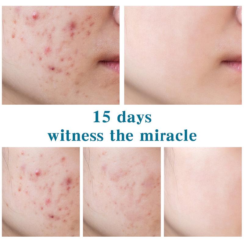 Kem Thu Nhỏ Lỗ Chân Lông Axit Salicylic, Xóa Mụn Nhanh Chóng, Loại Bỏ Lỗ Chân Lông Lớn, Loại Bỏ Mụn Đầu Đen, Làm Săn Chắc Da Mặt, Làm Mịn Da, Chăm Sóc Da, Sản Phẩm Mới 2024 4