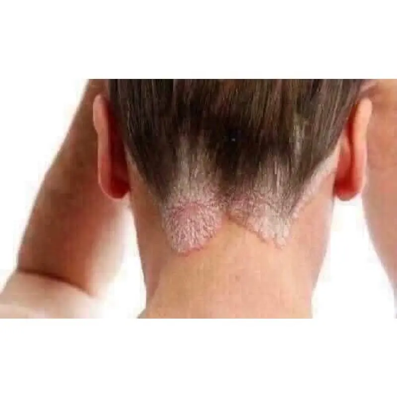 Kem bôi ngoài da clinoderm thái lan typ 15g 5