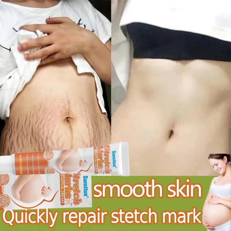 Kem Chống Rạn Da, Điều Trị Da Chuyên Sâu, Để Cải Thiện Và Loại Bỏ Sự Xuất Hiện Của Vết Rạn, Thích Hợp Để Loại Bỏ Vết Rạn Cắt, Hiệu Quả Để Loại Bỏ Đường Béo Và Vết Rạn Sau Sinh, Kem Phục Hồi Cơ Thể, Làm Sáng Da, Hiệu Quả Sau Khi Rạn Da 4