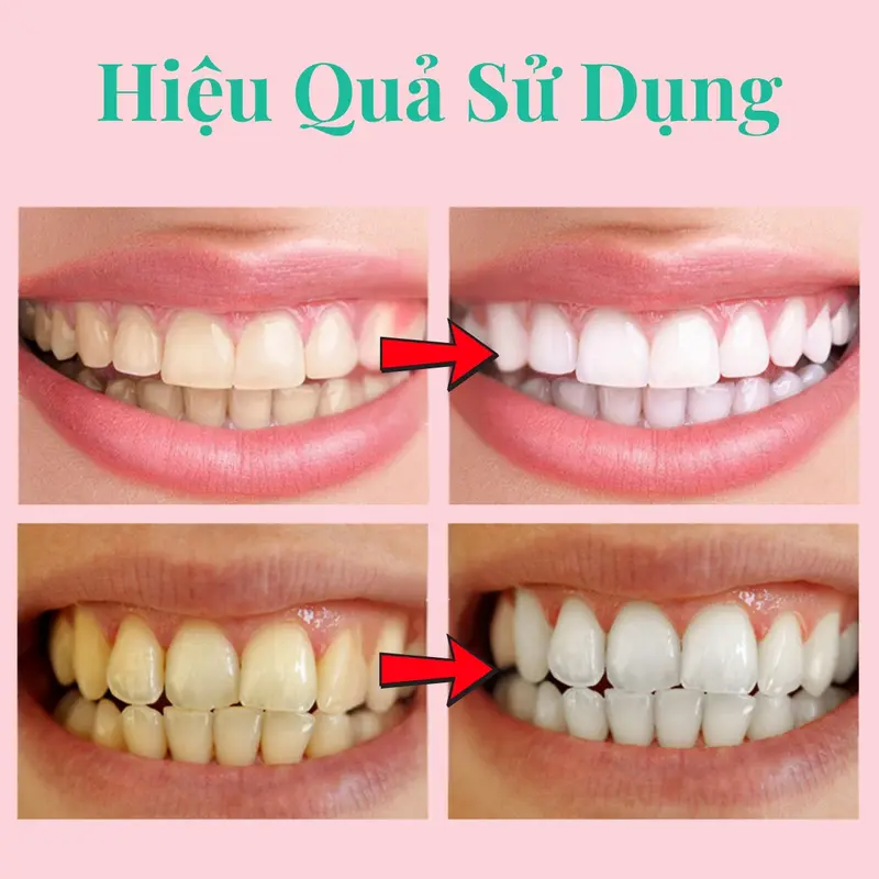 [COMBO TIẾT KIỆM] Kem Đánh Răng YAYASHI SP4 120 Gram, Hỗ Trợ Giảm Hôi Miệng, Hỗ Trọ Trắng Răng, Làm Sạch Răng Miệng, An Toàn Hiệu Quả, Răng Nữ Women. 3