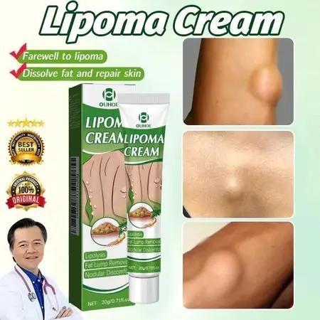 OUHOE Lipoma Cream Obat Benjolan Subkutan Lipoma Removal Cream Obat Salep Benjolan Lipoma Ampuh Herbal salep Lipoma 20g Lipoma Cream Obat Benjolan Subkutan Lipoma Removal Cream Obat Salep Benjolan Lipoma Ampuh Herbal salep Lipoma 20g