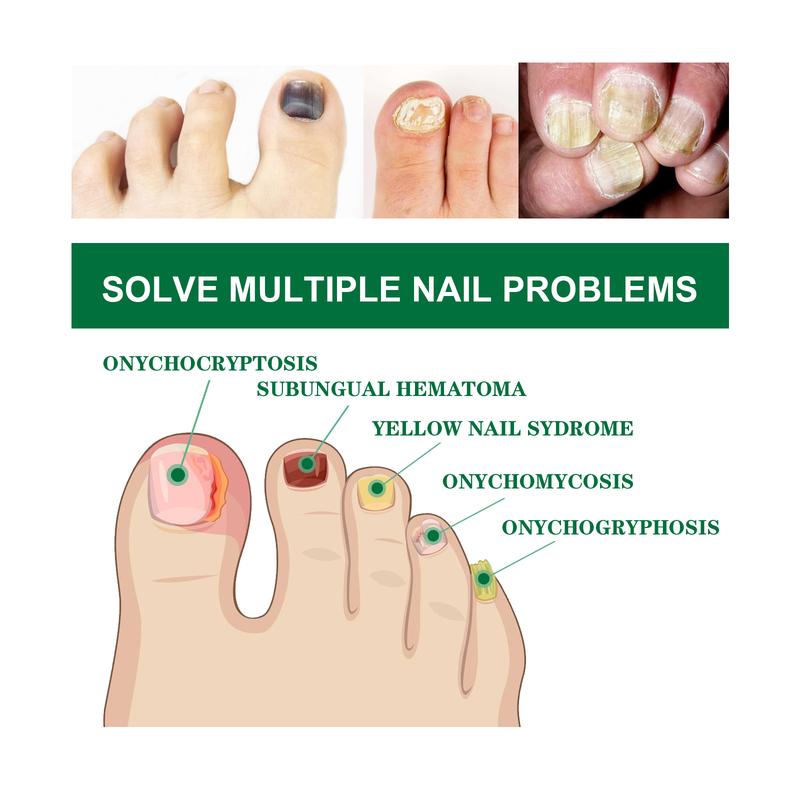 Product Introduction of 100% Original Brand Ouhoe Toenail Repair Essence Gray Nail Soft Yellow Thickening Inlay Bright Manicure Comfort 4