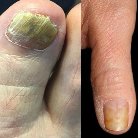 Emtrix hỗ trợ loạn dưỡng móng, móng thô giáp, hỏng móng an toàn khi sử dụng xuất xứ hà lan 6