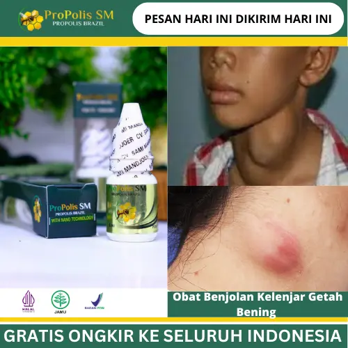 PROPOLIS SM Atasi Kelenjar Getah Bening di Leher Bengkak, Benjolan Kulit, infeksi telinga, pembengkakan kelenjar getah bening di leher, Radang amandel, Benjolan Di Pipi, Benjolan Tiroid Terasa Sakit, Bengkak, Nyeri Dengan Propolis SM