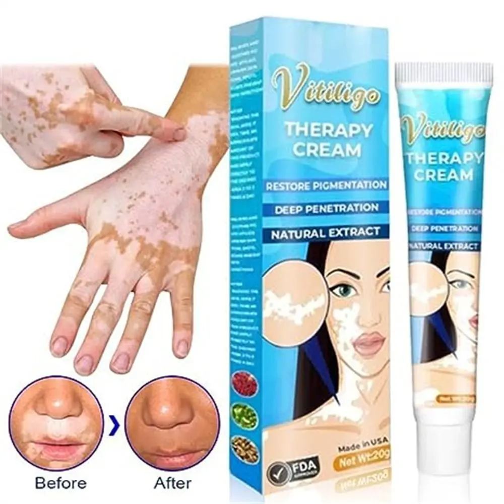Natural 20ml Vitiligo Therapy Cream Removing White Spots Antibacterial Skin Treatment Cream Relieving White Spot Skin Care Delaying Vitiligo Ointment Skin Care