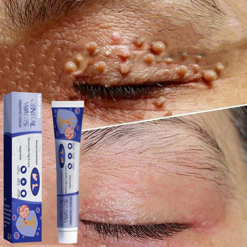 kem xoá mụn cóc,mụn thịt,loại bỏ mụn cóc thông thường,mụn đá,mụn cơm,mụn cóc dạng sợi 20g 0