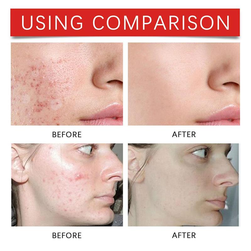 Product Introduction of 240pcs Salicylic Acid Acne Patch Colorful Heart Star Acne Shaped Pimple Patch N6S9 36