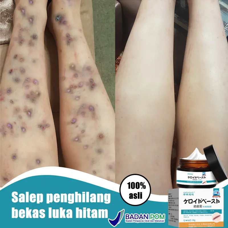 Salep Penghilang Bekas Luka Susu Tubuh Penghilang Bekas Luka Koreng Hitam Penghilang Bekas Luka Gigitan Nyamuk, Stretch Mark, Penghilang Bekas Luka Jahitan 0