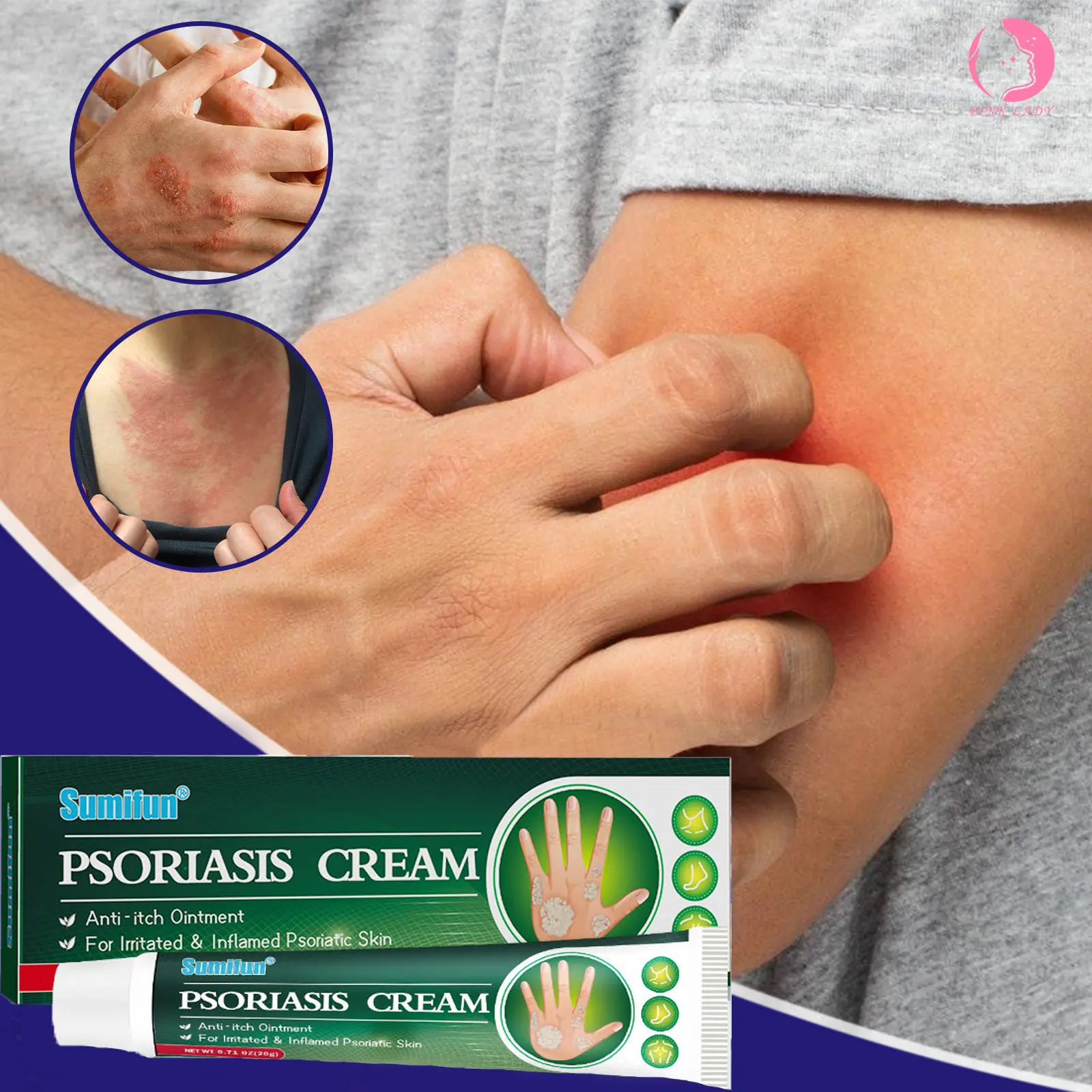 Sumifun psoriasis treatment cream 20g gamot sa kati kati sa balat ...