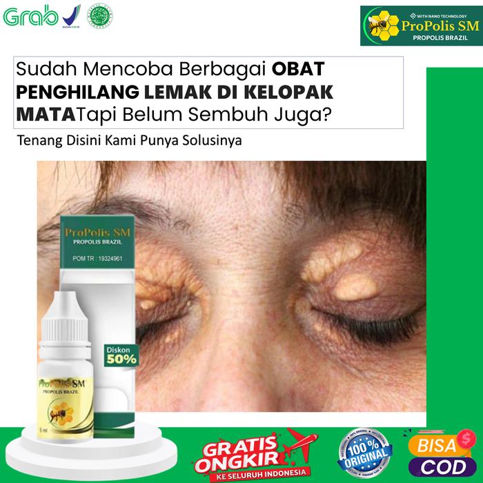 Gambar Propolis sm Untuk Xanthelasma Di Mata Pengendapan Kolesterol Di Kelopak Mata - Propolis sm dari Shakti Herbal Shop Kota Administrasi Jakarta Pusat Tokopedia