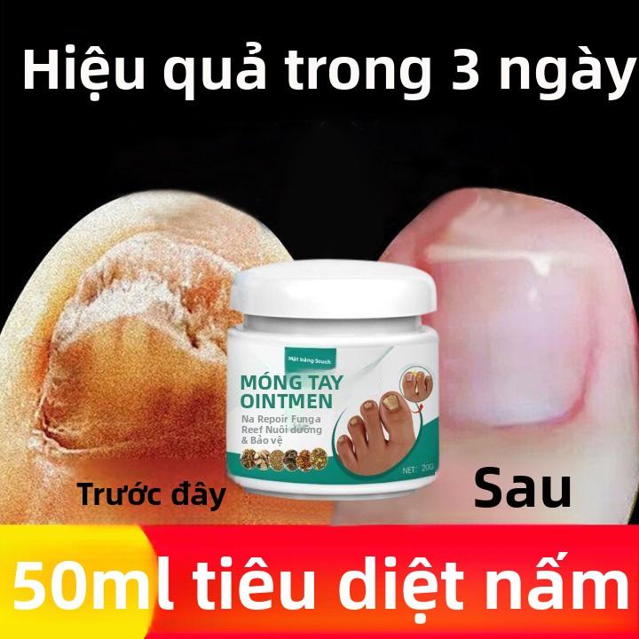 Kem Phục Hồi Móng Tay 100% Hiệu Quả Chất Lỏng Phục Hồi Nấm Móng Tay Phục Hồi Móng Tay Hư Tổn Nhanh Chóng Loại Bỏ Nấm Hiệu Quả Ngăn Ngừa Nấm Móng Tay Tinh Chất Chăm Sóc Móng Tay Huyết Thanh Phục Hồi Móng Tay 20g