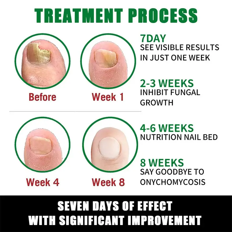 EELHOW Nail Repair Gel Strengthen Brighten Toenails Foot Nail Care Treatment Ginger Kutek 3