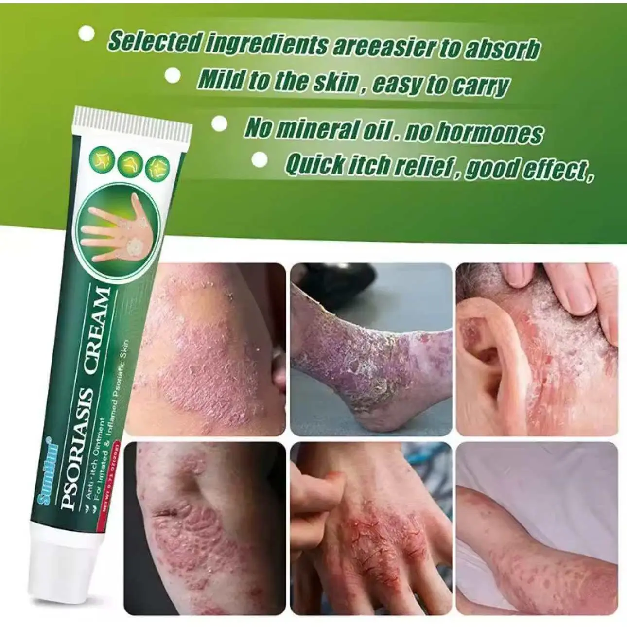 100% Effective Sumifun Eczema Treatment Antibacterial Cream Anti Itch ...