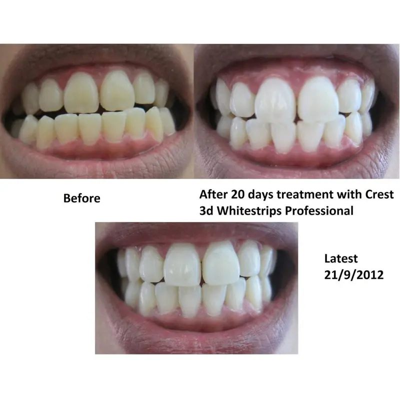Miếng dán trắng răng Crest 3D White Professional Effects - Mỹ 3