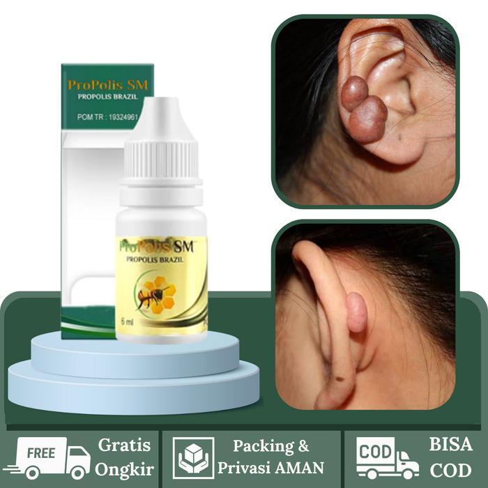 Gambar Salep Keloid Luka Tindik Di Telinga, Daging Jadi di Telinga dari Herbalthy Store Kota Administrasi Jakarta Barat Tokopedia