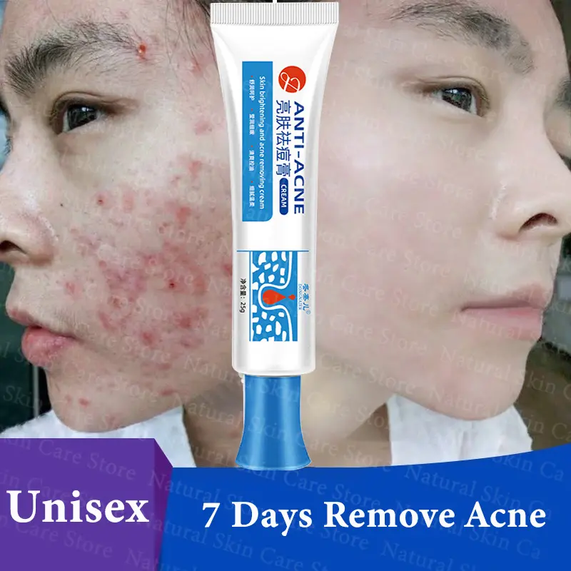 Kem Trị Mụn Trứng Cá, 100% Hiệu Quả, Loại Bỏ Mụn Nhanh Chóng, Làm Mờ Vết Mụn, Sửa Chữa Nốt Mụn, Chăm Sóc Sẹo Mặt, Thu Nhỏ Lỗ Chân Lông, Gelatine Nha Đam Và Nha Đam, Gel Làm Dịu Mụn Trứng Cá, Tẩy Mụn, Kem Trị Mụn, Kem Phục Hồi Mụn Trứng Cá, Chính Hãng