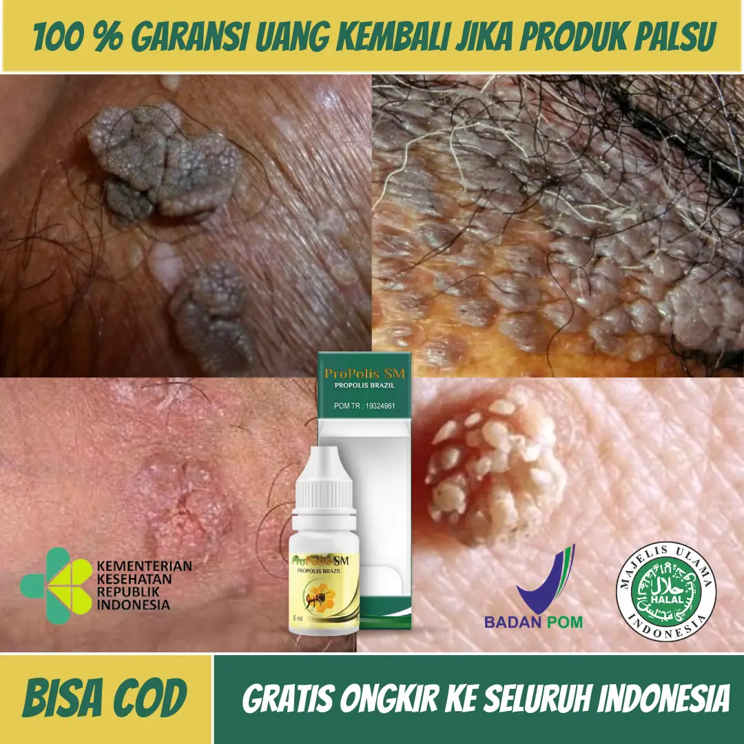 Perontok Kutil Kelamin, Papiloma, Skin Tag Daging Jadi Pria Dan Wanita Propolis SM Terlaris